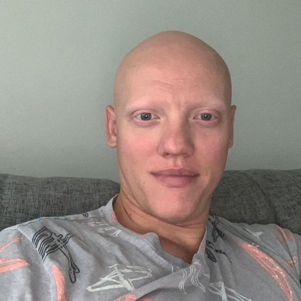 David's diagnosis of alopecia universalis before starting a clinical trial