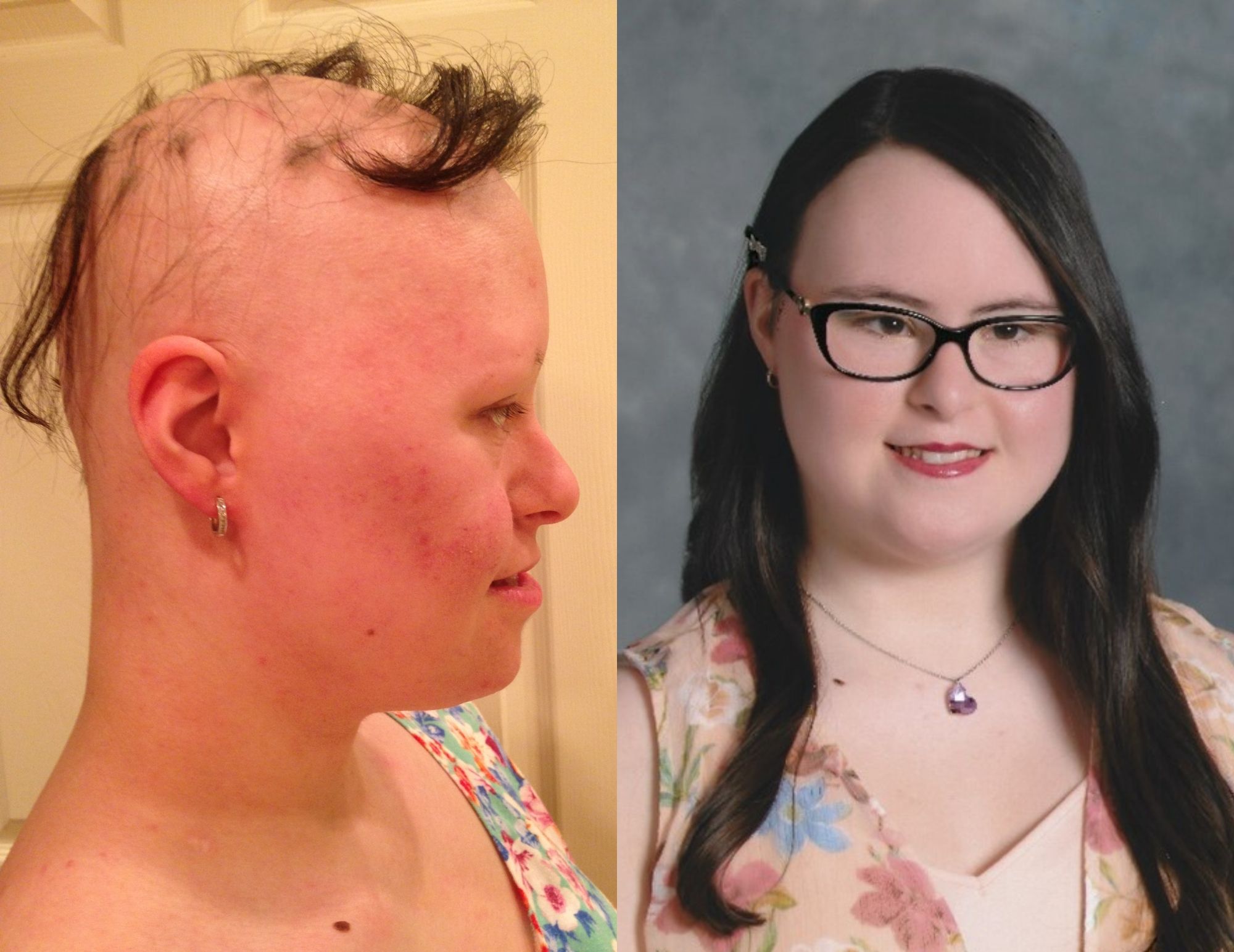 Jessica Rotolo before and after drug trial for alopecia areata