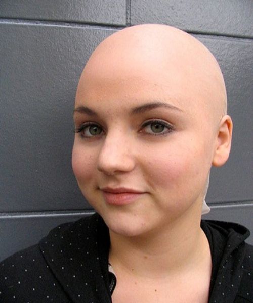 An individual with Alopecia Totalis