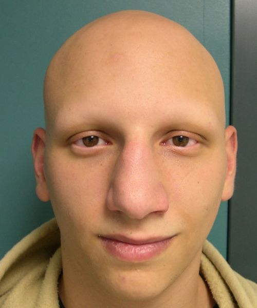 An individual with Alopecia Universalis