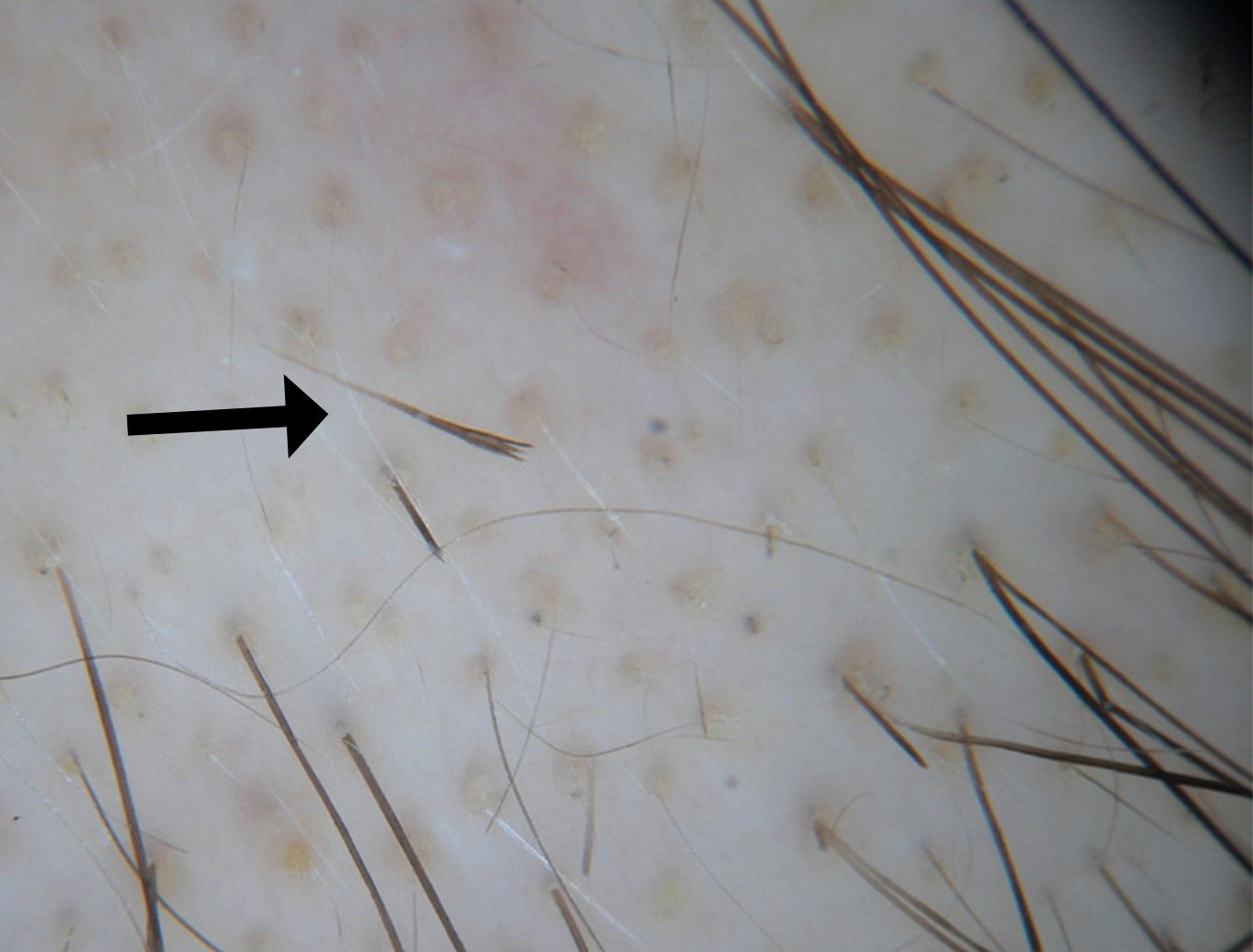 Exclamation Point Hairs can be an indicator of Alopecia Areata 