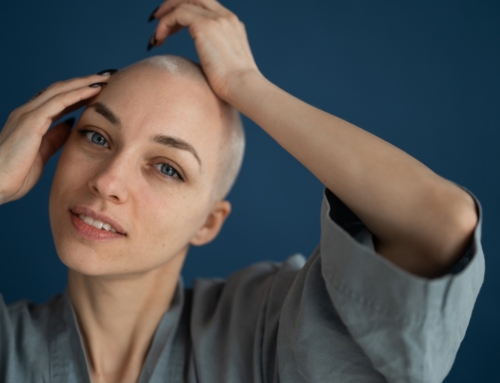 A New Treatment for Severe Alopecia Areata Has Been Approved in the USA!