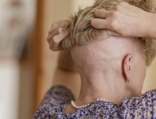 Alopecia areata: Navigating the emotional toll and financial burden of an unpredictable disease